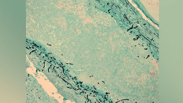 What is fungal meningitis after two Americans die from the infection contracted in Mexico