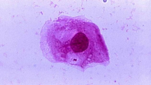 Patients with HIV in US saw rise of rare, deadly bacterial illness last year: CDC