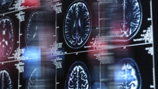 Innovations in Alzheimer’s treatment risk leaving Hispanic community behind, experts say