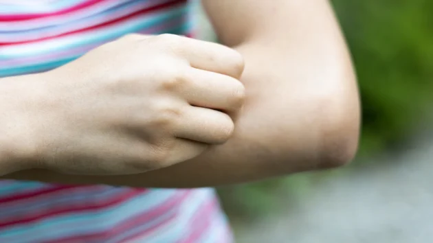 ER visits for tick bites near record levels this summer across US