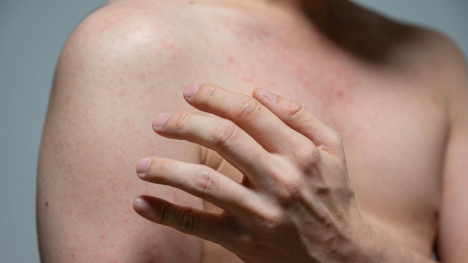 Measles exposure reported at Universal Studios Hollywood